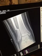 fibula2